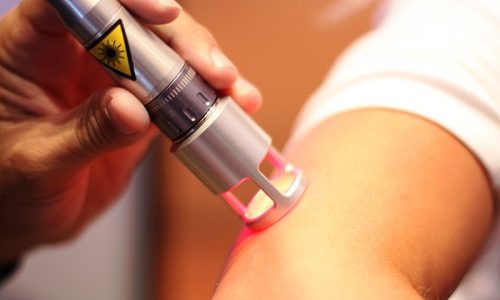 man getting k-laser therapy on his arm